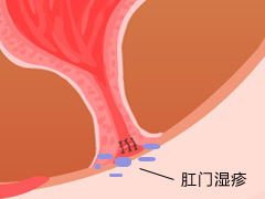 无锡肛周湿疹的治疗